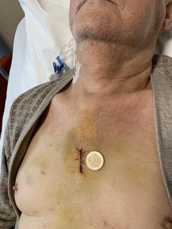 Bentall Ameliyatı Nedir? Kimler İçin Gereklidir?