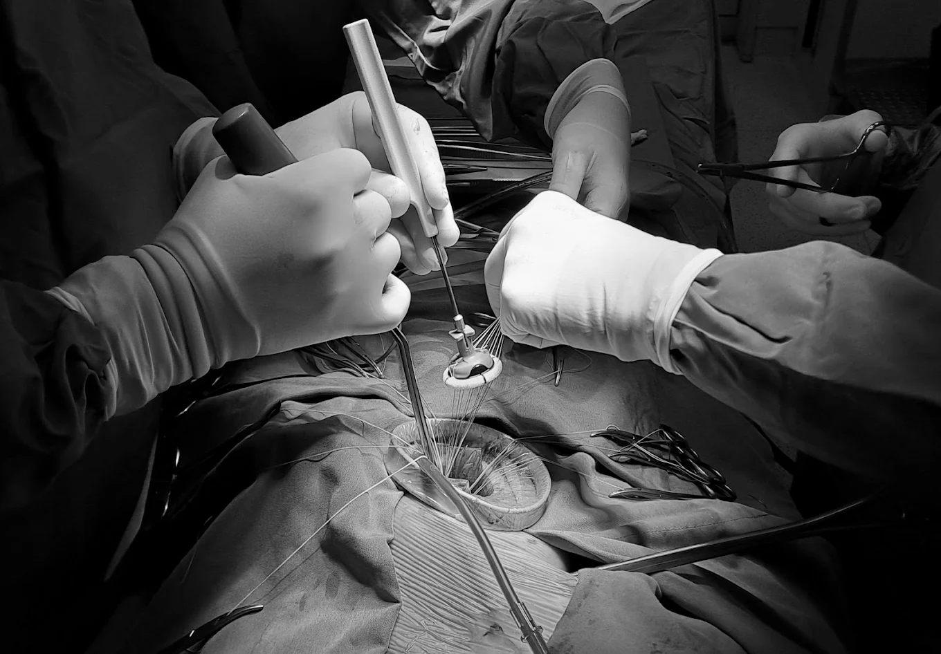 Kalp Kapağı Değiştirme Ameliyatının Aşamaları