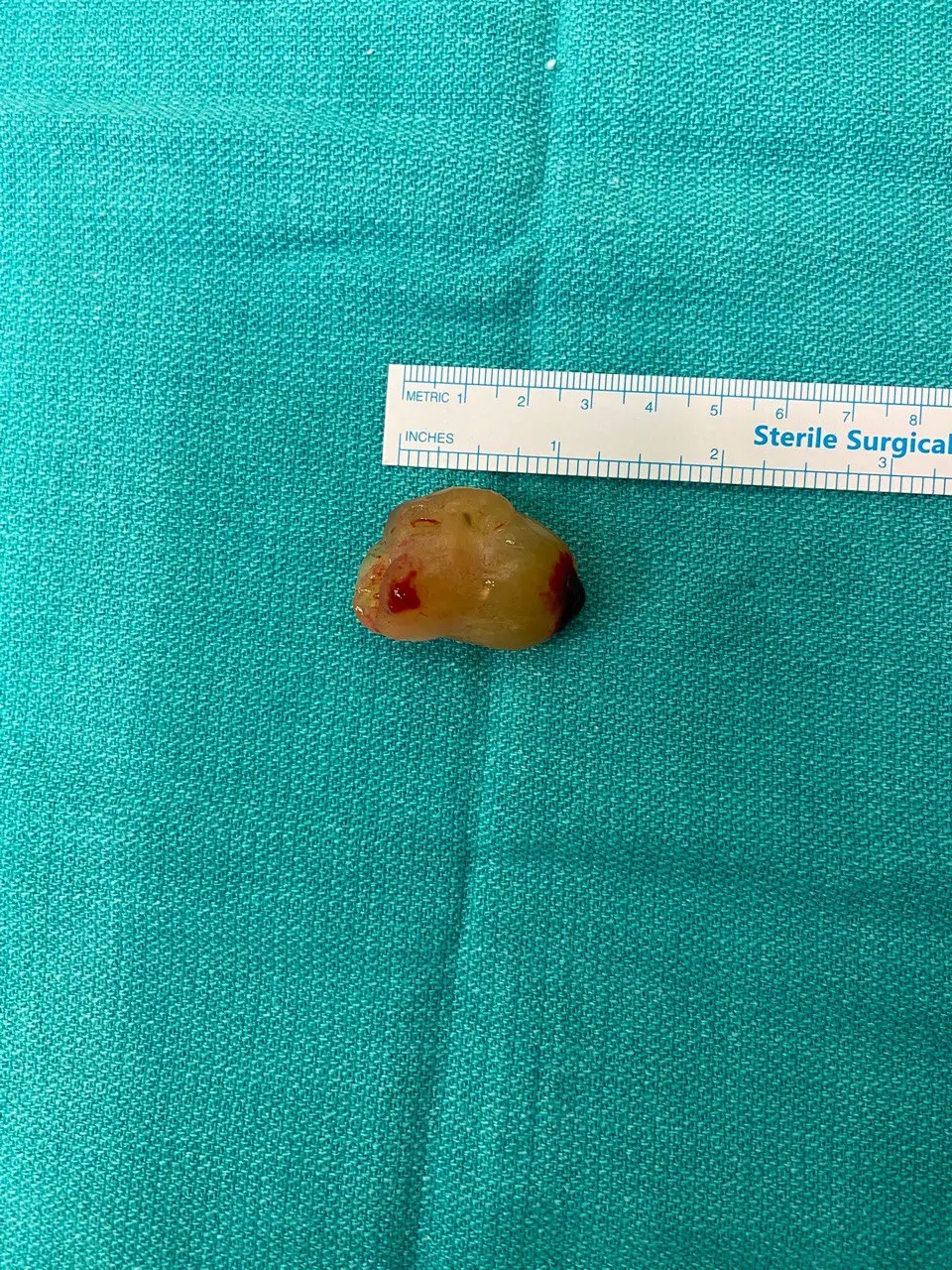 Kapalı Kalp Ameliyatı ile Kalp Tümörü (Mixoma) Ameliyatı