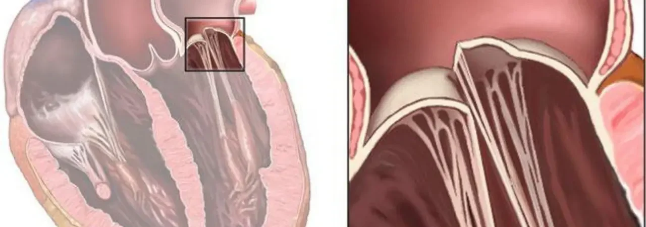Mitral Kapak Prolapsusu: Tanı ve Tedavi Yöntemleri