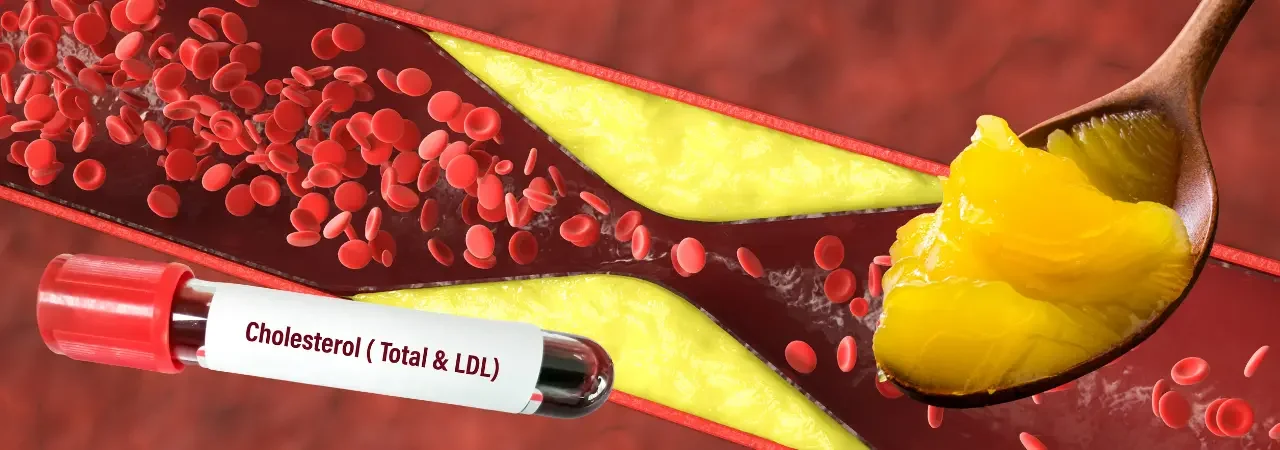 Kolesterol ve Kalp Hastalıkları Arasındaki Bağlantı